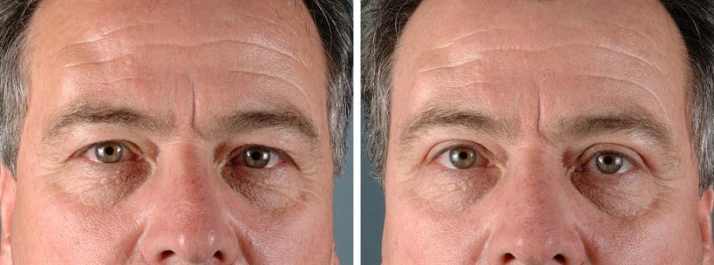 Albuquerque Center for Plastic Surgery, William G. Loutfy MD eyelid lift result — Albuquerque, NM