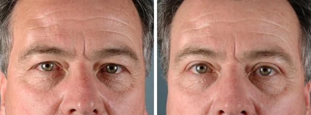 Blepharoplasty result at Albuquerque Center for Plastic Surgery, William G. Loutfy MD in Albuquerque, NM