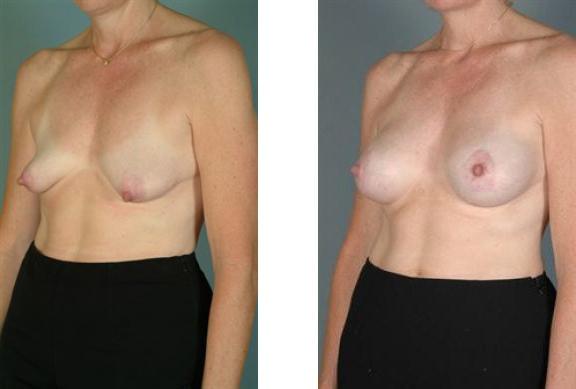 Albuquerque Center for Plastic Surgery, William G. Loutfy MD breast lift result — Albuquerque, NM