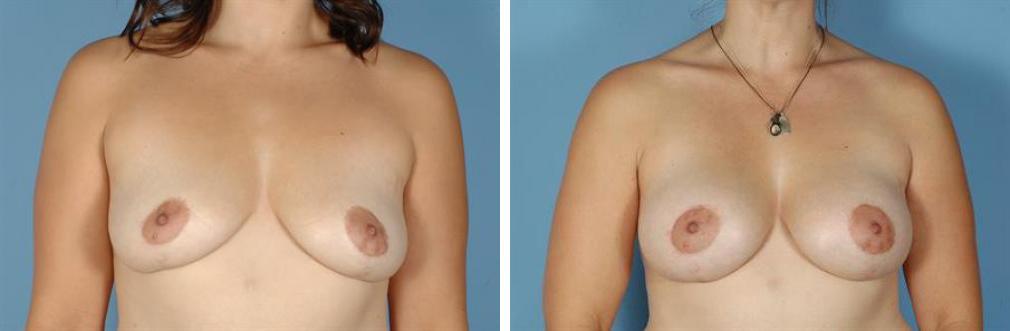 Albuquerque Center for Plastic Surgery, William G. Loutfy MD result — Albuquerque, NM