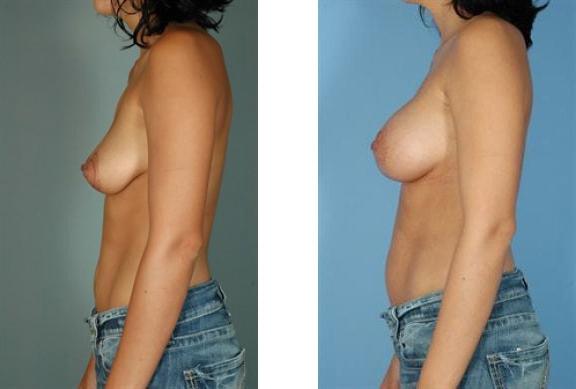 Breast Lift result at Albuquerque Center for Plastic Surgery, William G. Loutfy MD in Albuquerque, NM