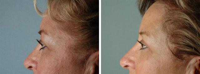 Blepharoplasty result at Albuquerque Center for Plastic Surgery, William G. Loutfy MD in Albuquerque, NM