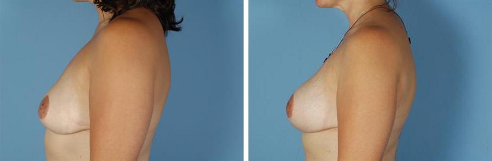 Albuquerque Center for Plastic Surgery, William G. Loutfy MD breast lift result — Albuquerque, NM