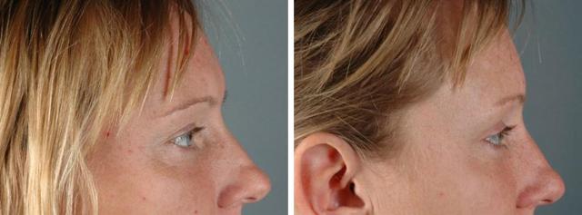 Blepharoplasty result at Albuquerque Center for Plastic Surgery, William G. Loutfy MD in Albuquerque, NM