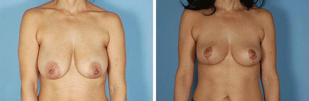 Albuquerque Center for Plastic Surgery, William G. Loutfy MD result — Albuquerque, NM