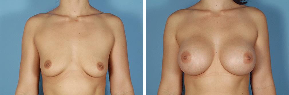 Albuquerque Center for Plastic Surgery, William G. Loutfy MD result — Albuquerque, NM