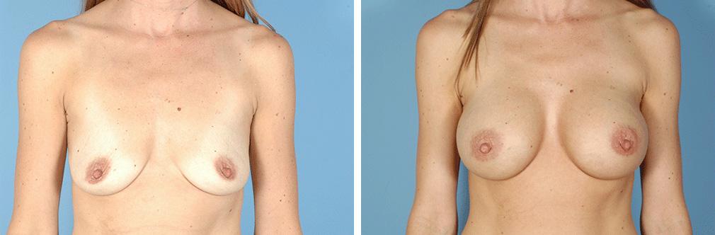 Albuquerque Center for Plastic Surgery, William G. Loutfy MD result — Albuquerque, NM