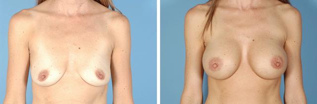 Breast Augmentation result at Albuquerque Center for Plastic Surgery, William G. Loutfy MD in Albuquerque, NM
