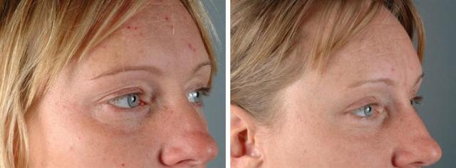 Blepharoplasty result at Albuquerque Center for Plastic Surgery, William G. Loutfy MD in Albuquerque, NM