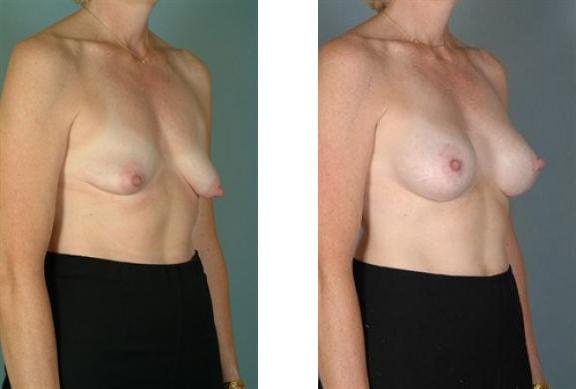 Breast Lift result at Albuquerque Center for Plastic Surgery, William G. Loutfy MD in Albuquerque, NM