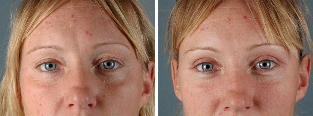 Albuquerque Center for Plastic Surgery, William G. Loutfy MD eyelid lift result — Albuquerque, NM