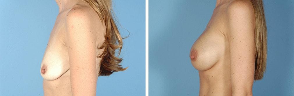 Albuquerque Center for Plastic Surgery, William G. Loutfy MD breast augmentation result — Albuquerque, NM