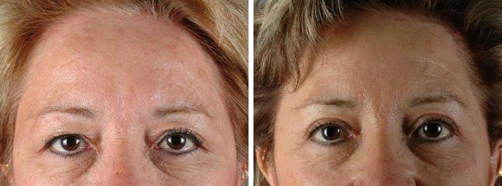 Albuquerque Center for Plastic Surgery, William G. Loutfy MD eyelid lift result — Albuquerque, NM