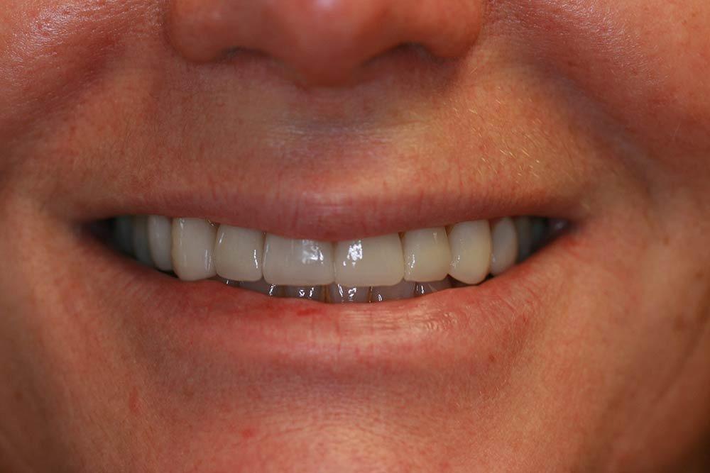 Highland Heights Dental veneers after — Millcreek, UT