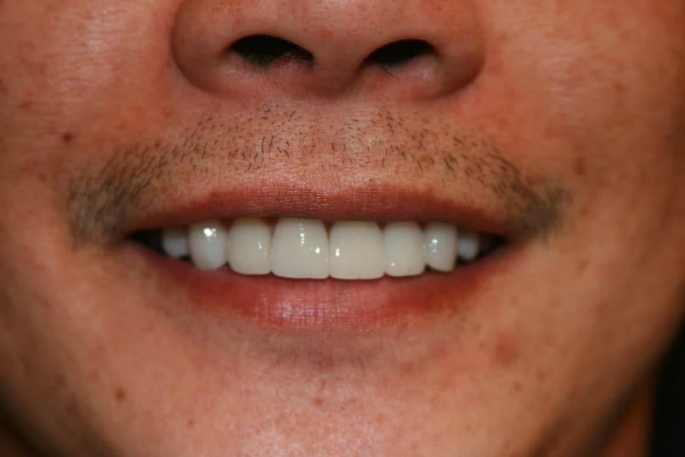 Highland Heights Dental veneers after — Millcreek, UT