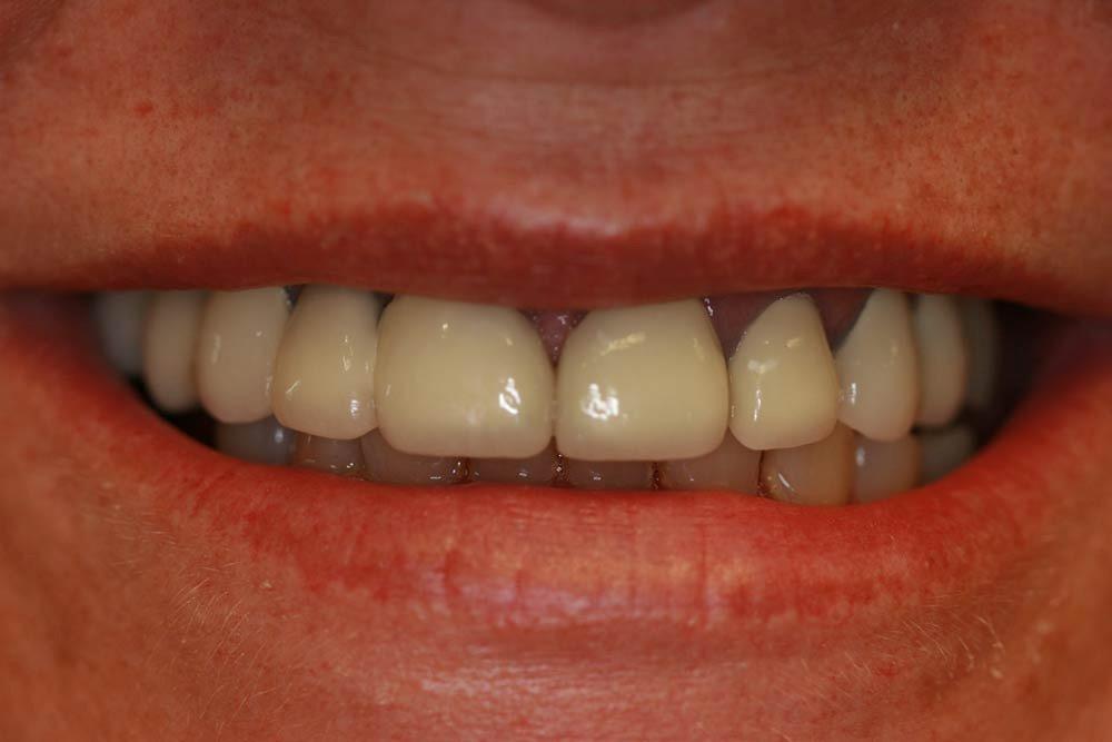 Highland Heights Dental veneers after — Millcreek, UT