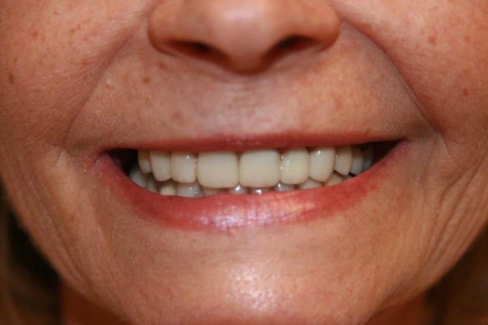 Highland Heights Dental veneers after — Millcreek, UT