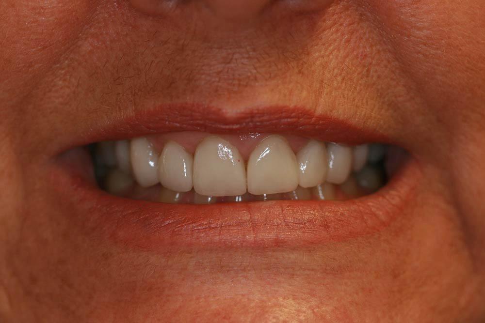 Highland Heights Dental veneers after — Millcreek, UT