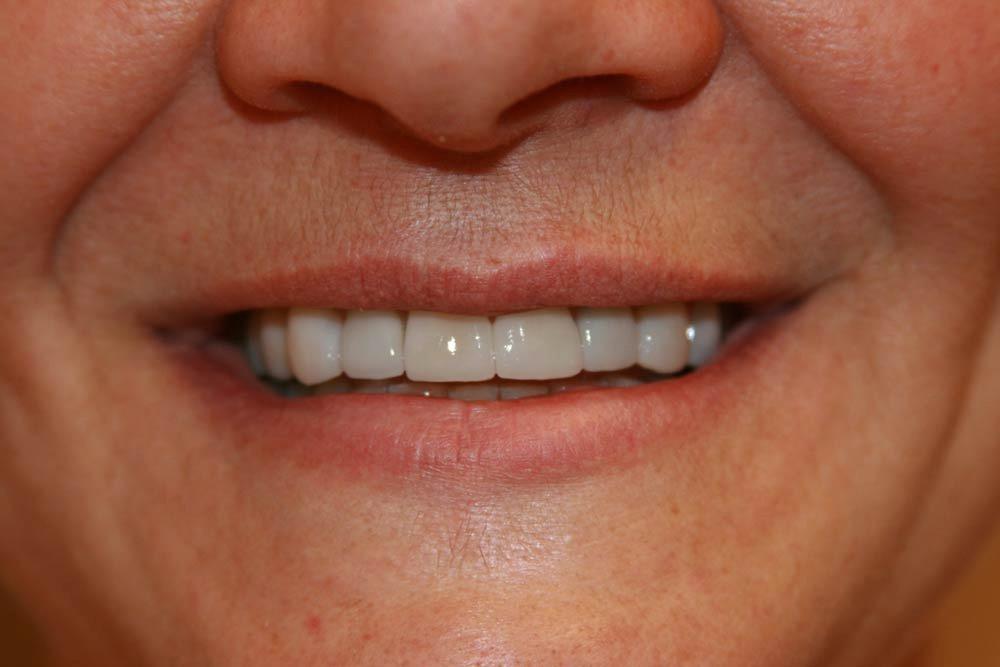 Highland Heights Dental veneers after — Millcreek, UT