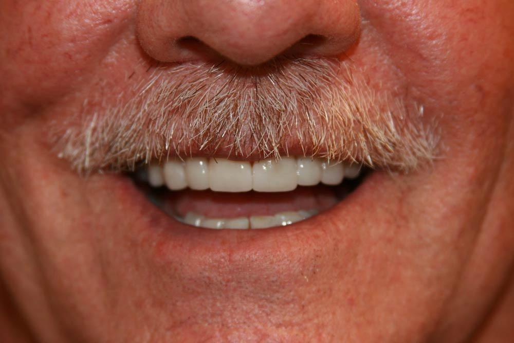 Highland Heights Dental veneers after — Millcreek, UT