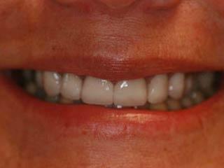 Highland Heights Dental veneers after — Millcreek, UT