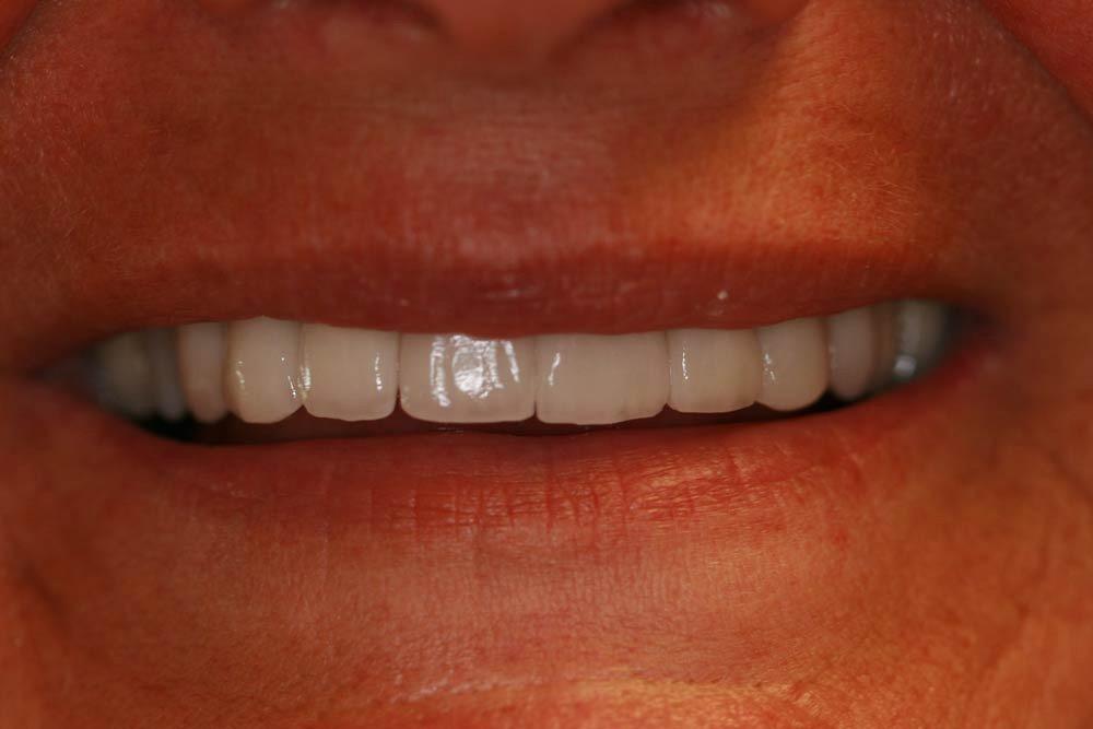 Highland Heights Dental veneers after — Millcreek, UT