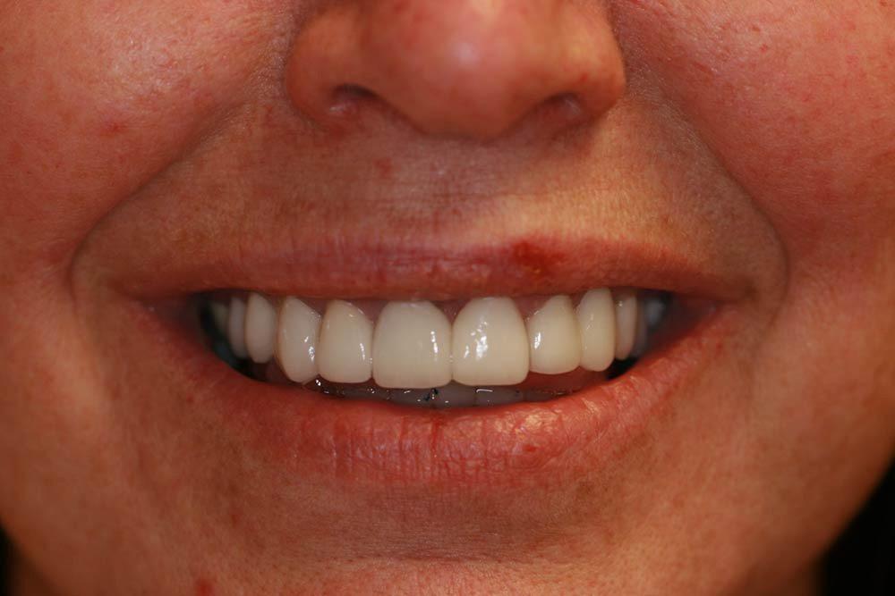Highland Heights Dental veneers after — Millcreek, UT