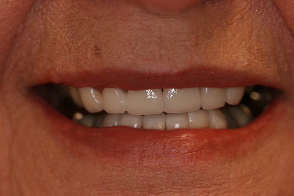 Highland Heights Dental veneers after — Millcreek, UT