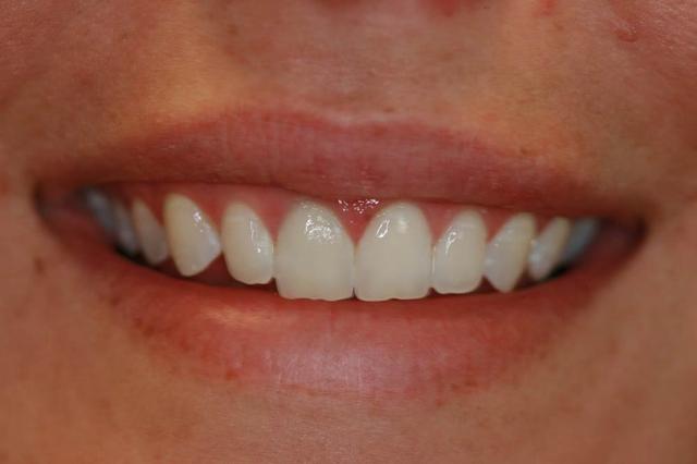 Teeth Whitening after at Highland Heights Dental in Millcreek, UT