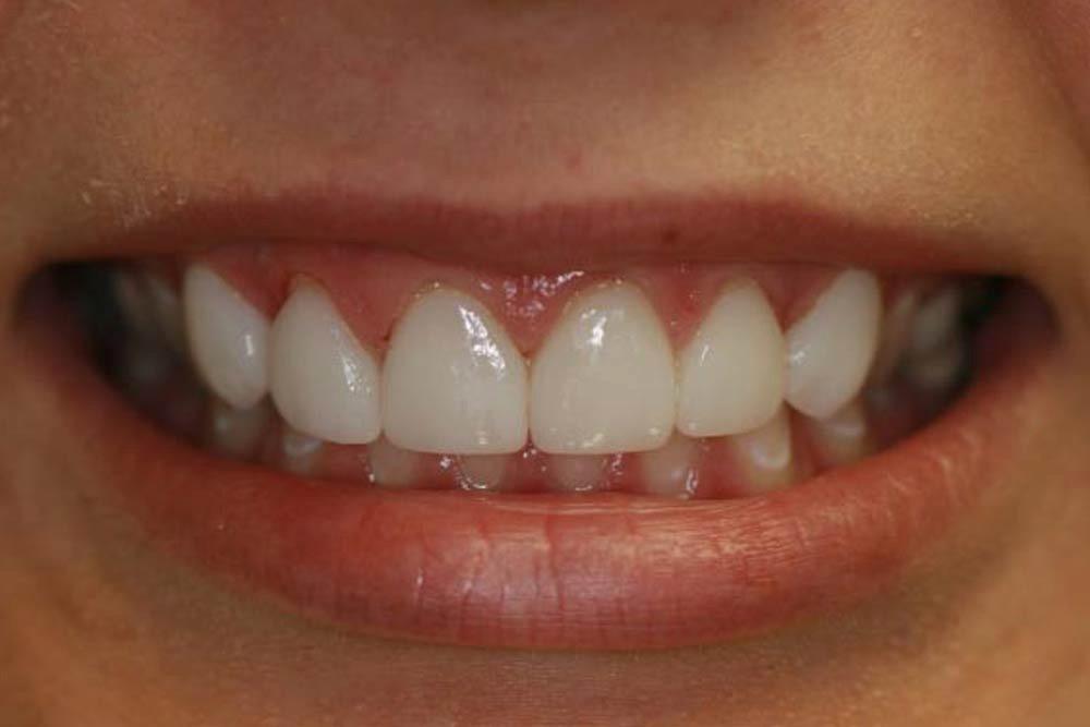 Highland Heights Dental veneers after — Millcreek, UT