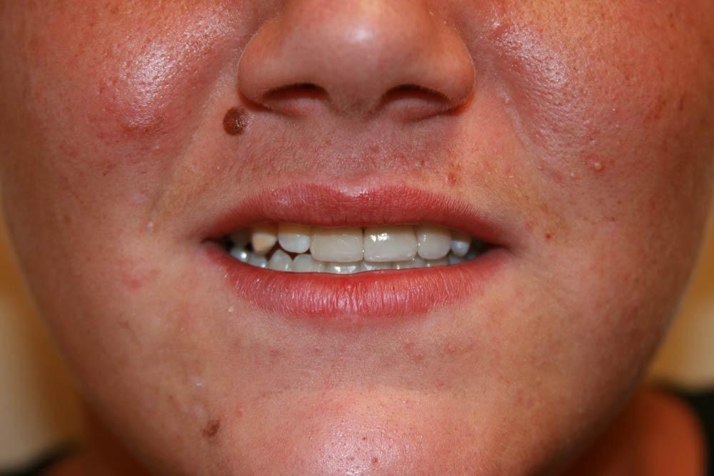 Highland Heights Dental veneers after — Millcreek, UT