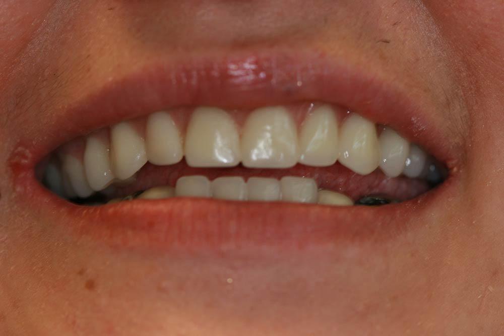 Highland Heights Dental veneers after — Millcreek, UT
