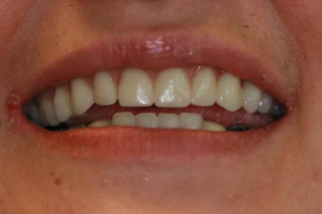 Dental Veneers after at Highland Heights Dental in Millcreek, UT