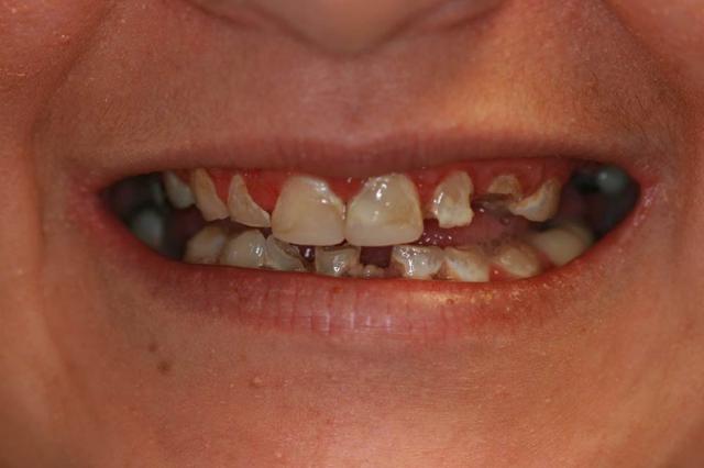 Dental Veneers before at Highland Heights Dental in Millcreek, UT