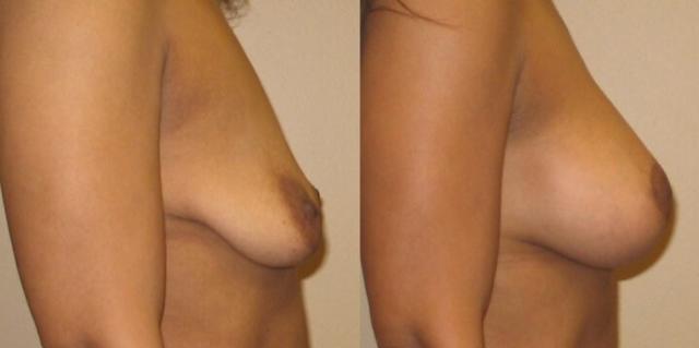 Breast Lift result at Maier Plastic Surgery in Cincinnati, OH