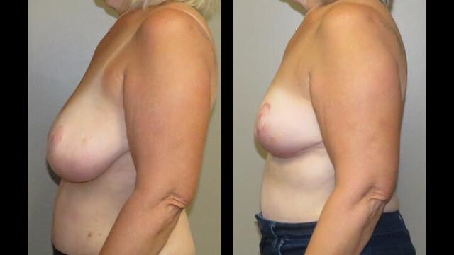 Breast Lift result at Maier Plastic Surgery in Cincinnati, OH
