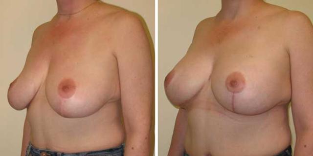 Breast Lift result at Maier Plastic Surgery in Cincinnati, OH