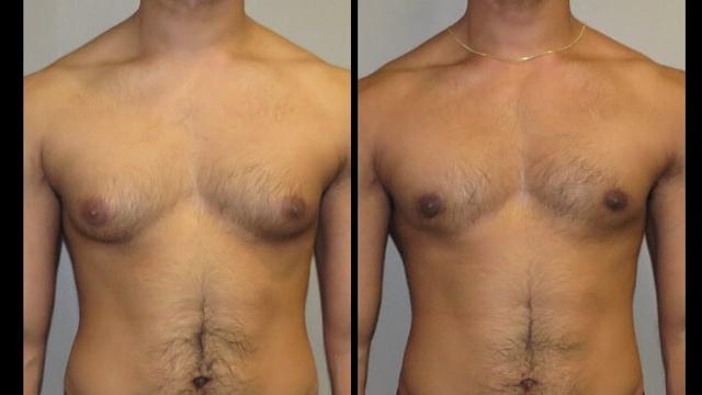 Gynecomastia Surgery result at Maier Plastic Surgery in Cincinnati, OH