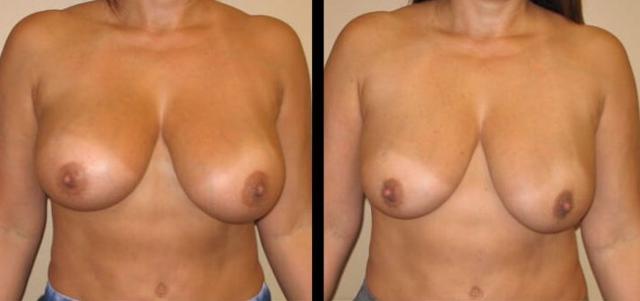 Breast Augmentation result at Maier Plastic Surgery in Cincinnati, OH
