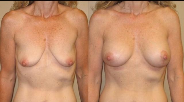 Breast Lift result at Maier Plastic Surgery in Cincinnati, OH