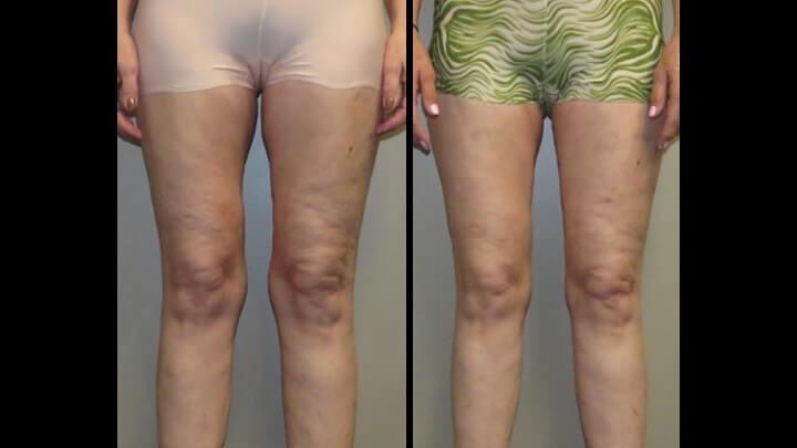 Maier Plastic Surgery liposuction result — Cincinnati, OH