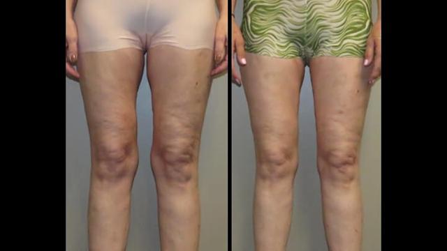 Liposuction result at Maier Plastic Surgery in Cincinnati, OH