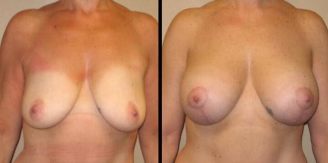 Breast Lift result at Maier Plastic Surgery in Cincinnati, OH