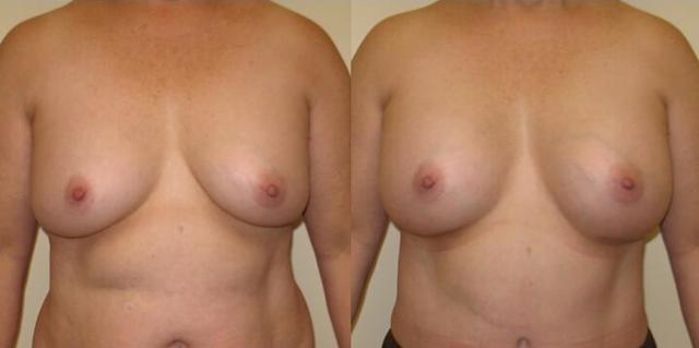 Breast Augmentation result at Maier Plastic Surgery in Cincinnati, OH