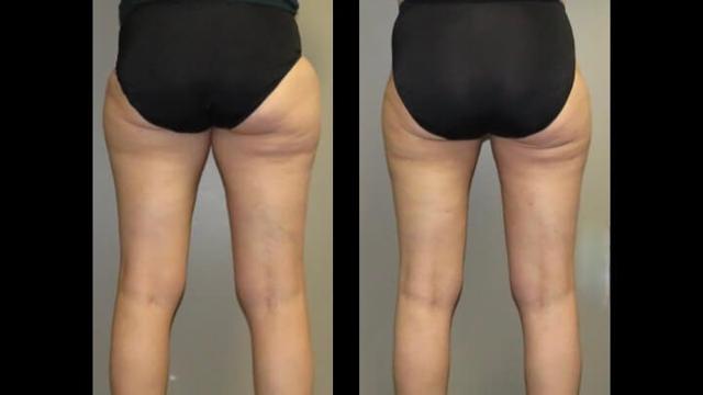 Liposuction result at Maier Plastic Surgery in Cincinnati, OH
