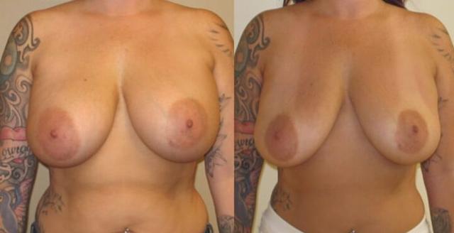 Breast Augmentation result at Maier Plastic Surgery in Cincinnati, OH