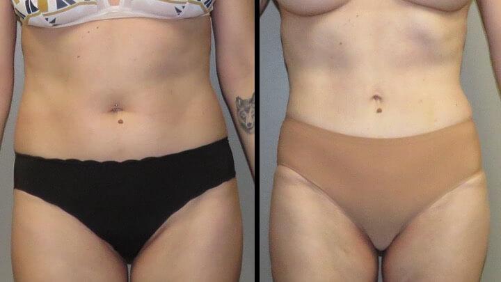 Maier Plastic Surgery liposuction result — Cincinnati, OH