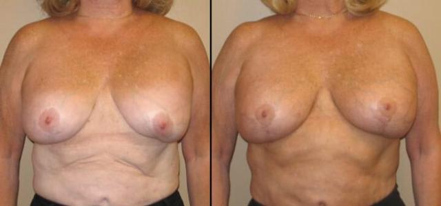 Breast Augmentation result at Maier Plastic Surgery in Cincinnati, OH
