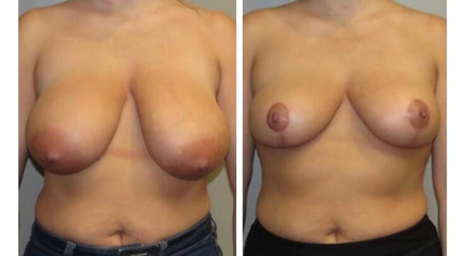 Breast Lift result at Maier Plastic Surgery in Cincinnati, OH
