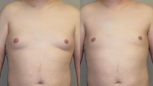 Breast Reduction result at Maier Plastic Surgery in Cincinnati, OH